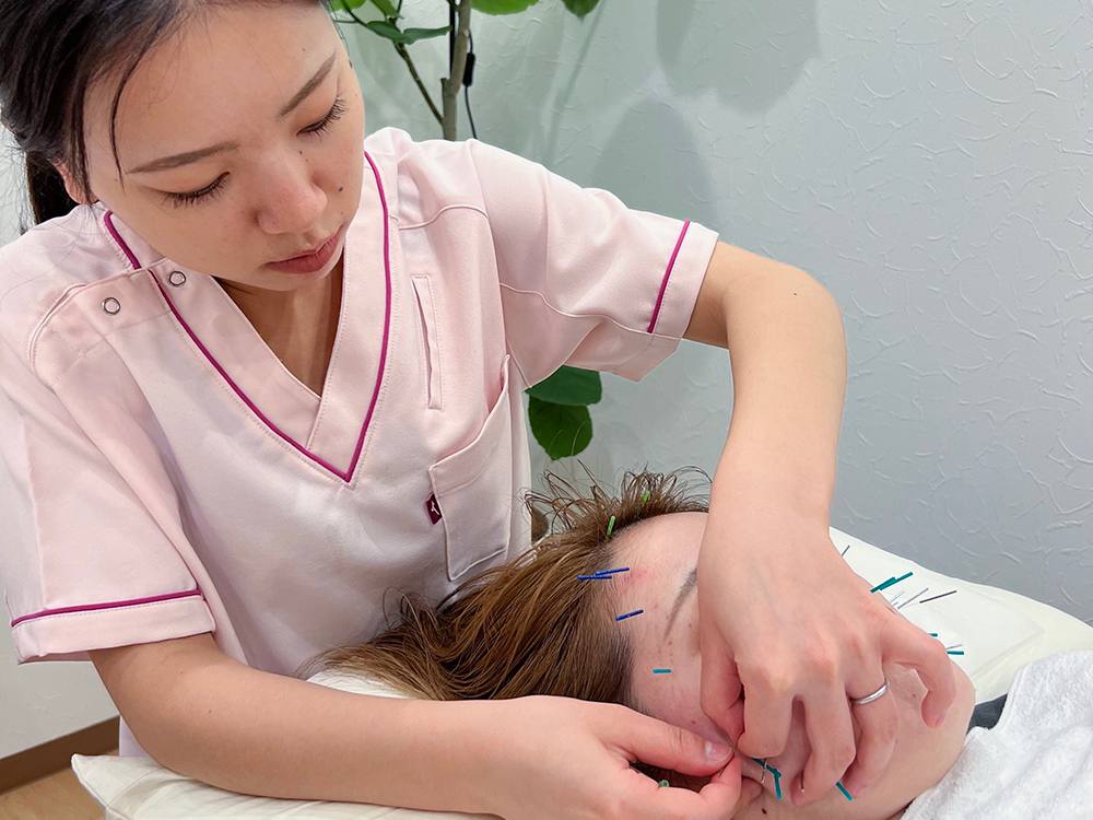 美容鍼の施術